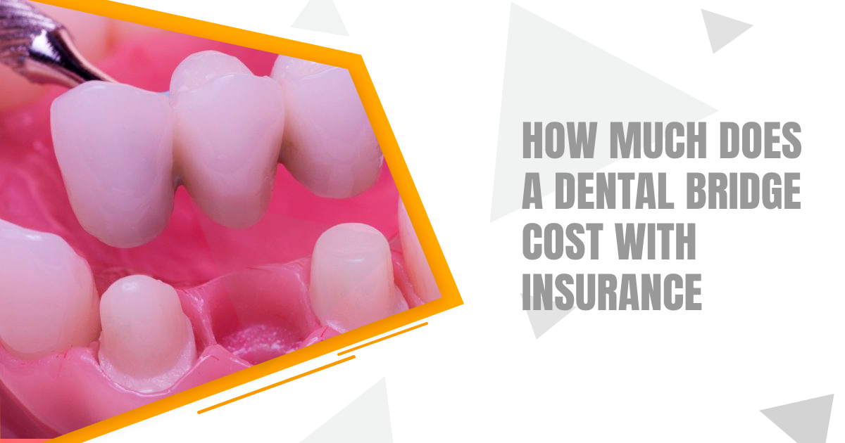 How Much Does A Dental Bridge Cost With Insurance
