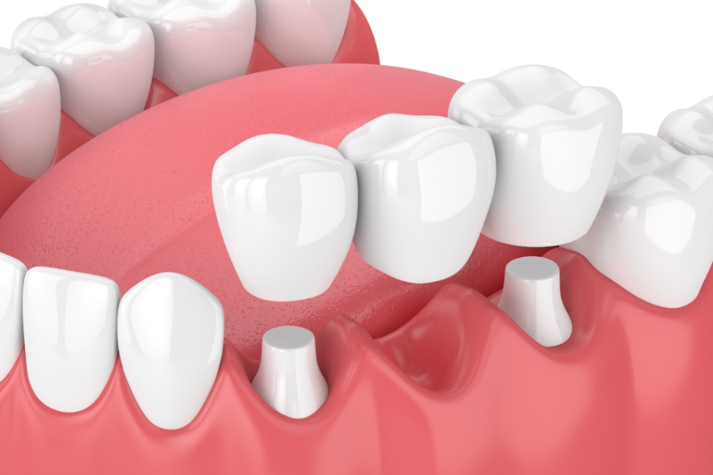 How Much Does A Dental Bridge Cost Without Insurance