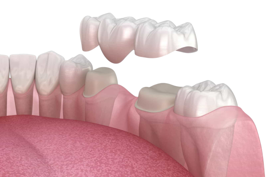 How Much Does A Dental Bridge Cost With Insurance